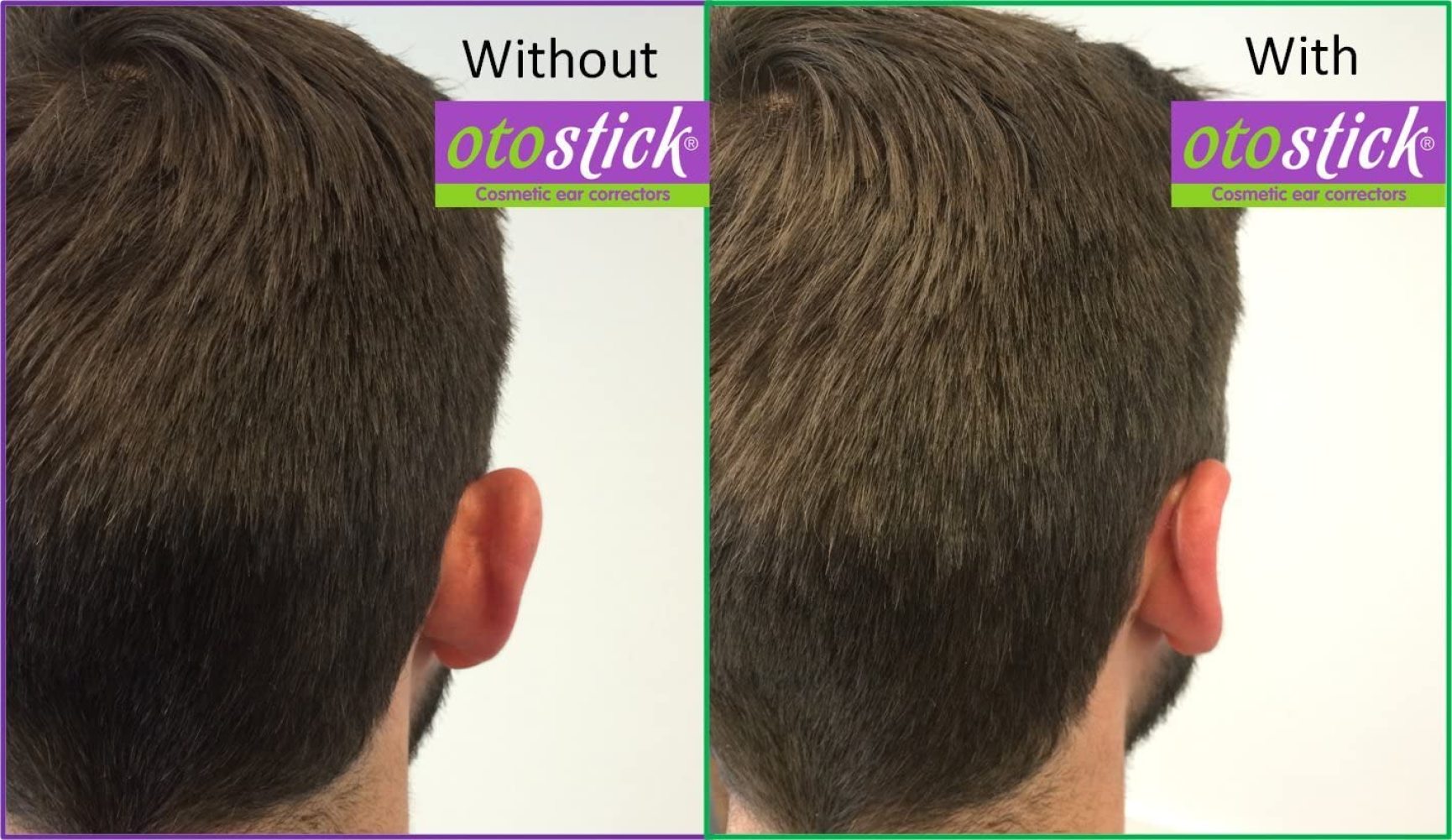 Otostick - TRIPLE PACK -(ENGLISH VERSION )- Instant Correction for  Prominent Ears - Best Alternative Short of Surgery